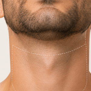 Depilación Cuello Anterior Hombre
